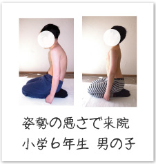 姿勢の悪さの改善例