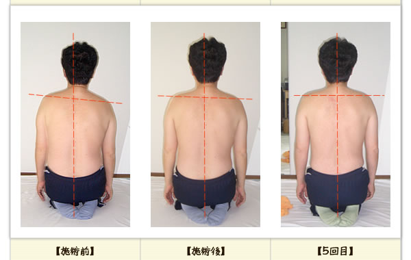 腰椎椎間板ヘルニアの改善例