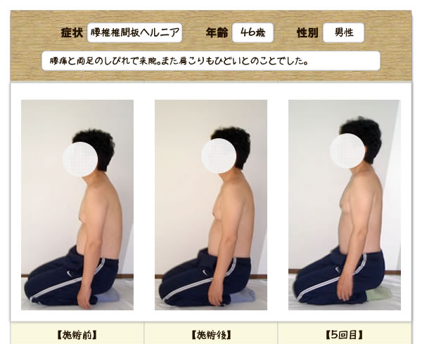 腰椎椎間板ヘルニアの改善例