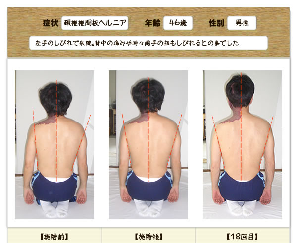 頚椎椎間板ヘルニアの改善例