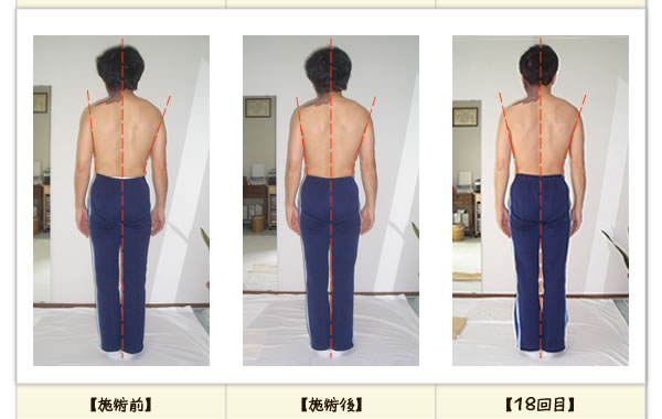 頚椎椎間板ヘルニアの改善例