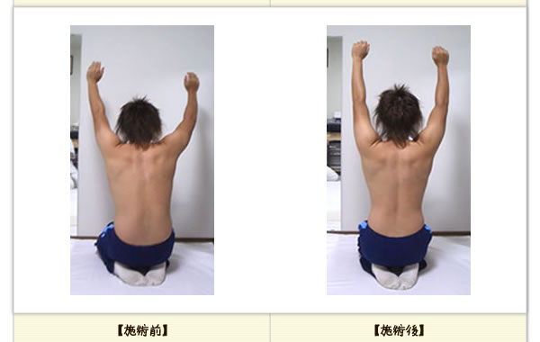 背中の痛みの改善例