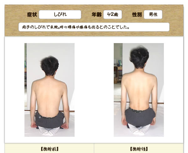 しびれの改善例