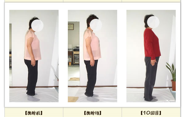腰痛の改善例