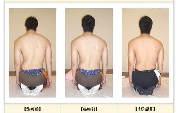 腰痛の改善例