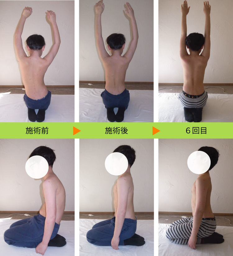 子供の姿勢：小学生６年の症例